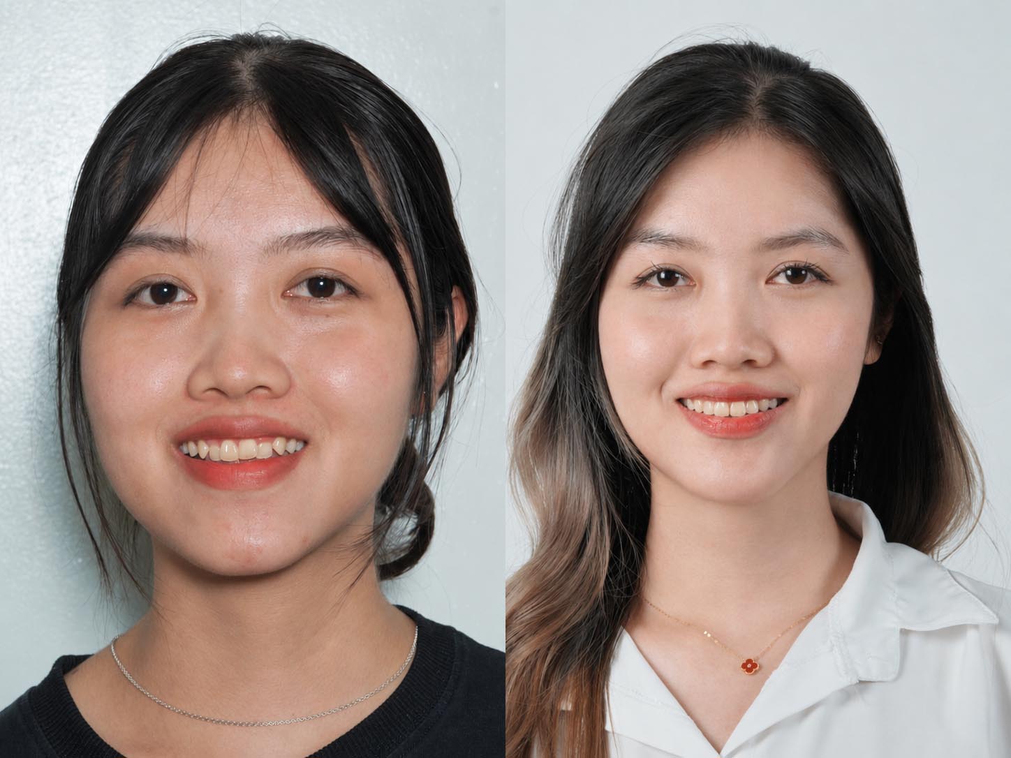 ảnh trước và sau khi niềng răng của Hiền, răng đều đẹp, hàm hết móm