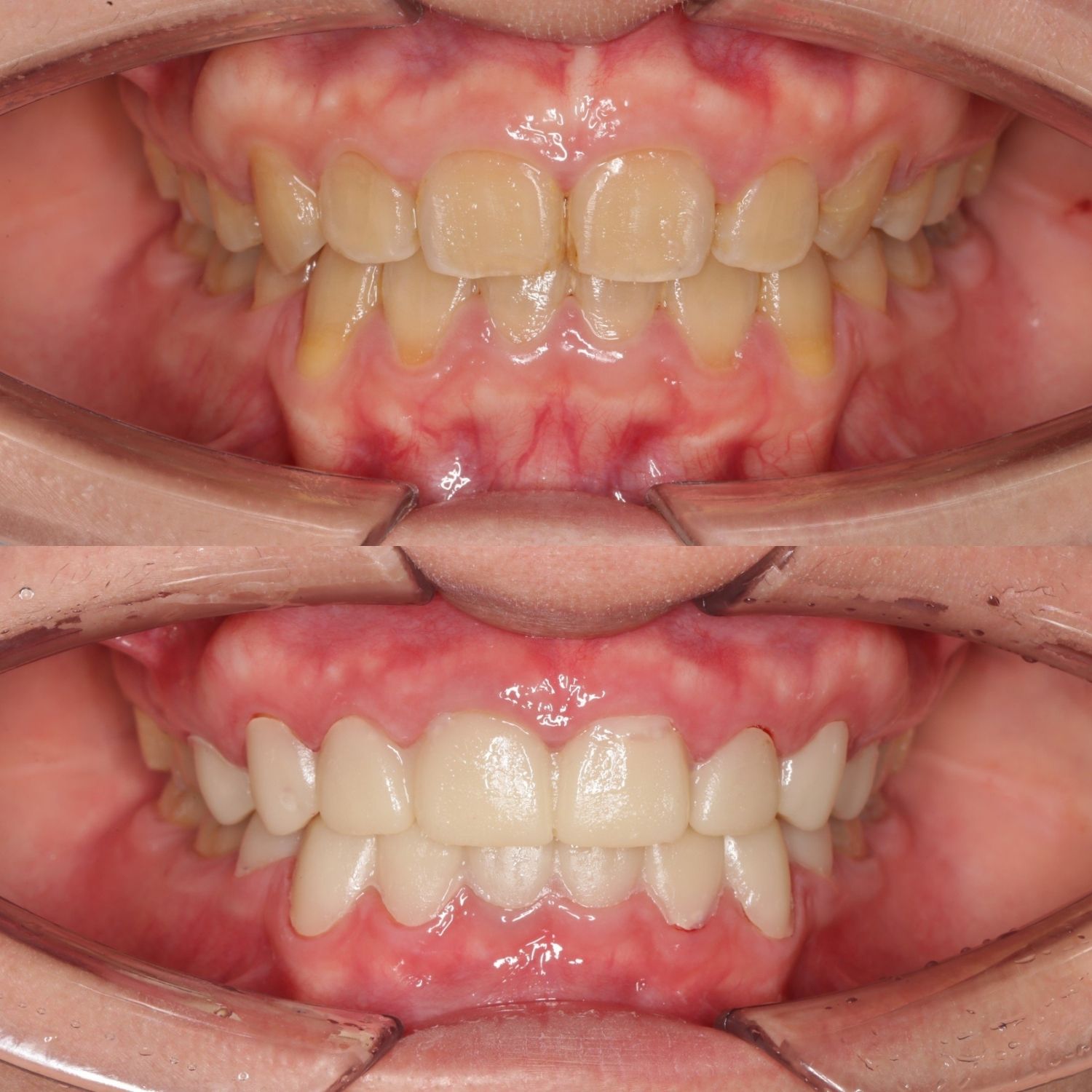 ảnh trước và sau khi dán sứ veneer của Tâm