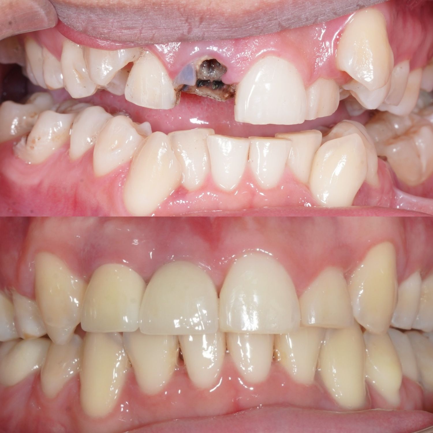 sự thay đổi rõ rệt của Bình Trọng sau khi chỉnh nha và phục hình răng