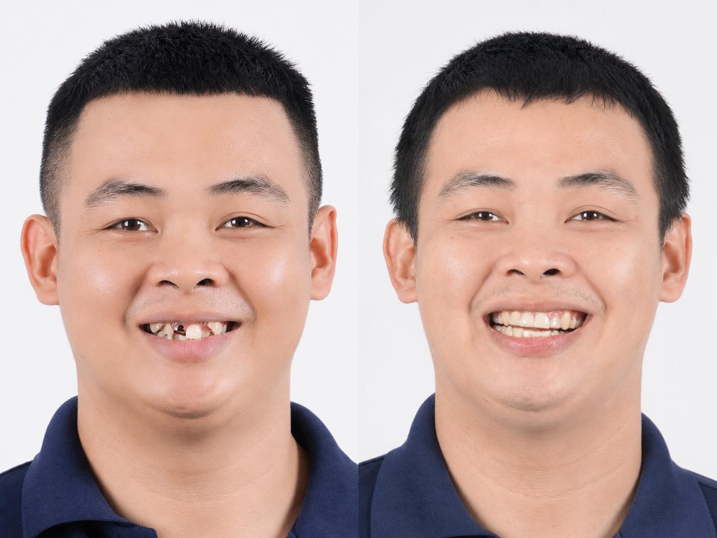 Bình Trọng sở hữu nụ cười cân đối sau khi chỉnh nha và phục hình răng. ảnh so sánh thấy rõ sự thay đổi