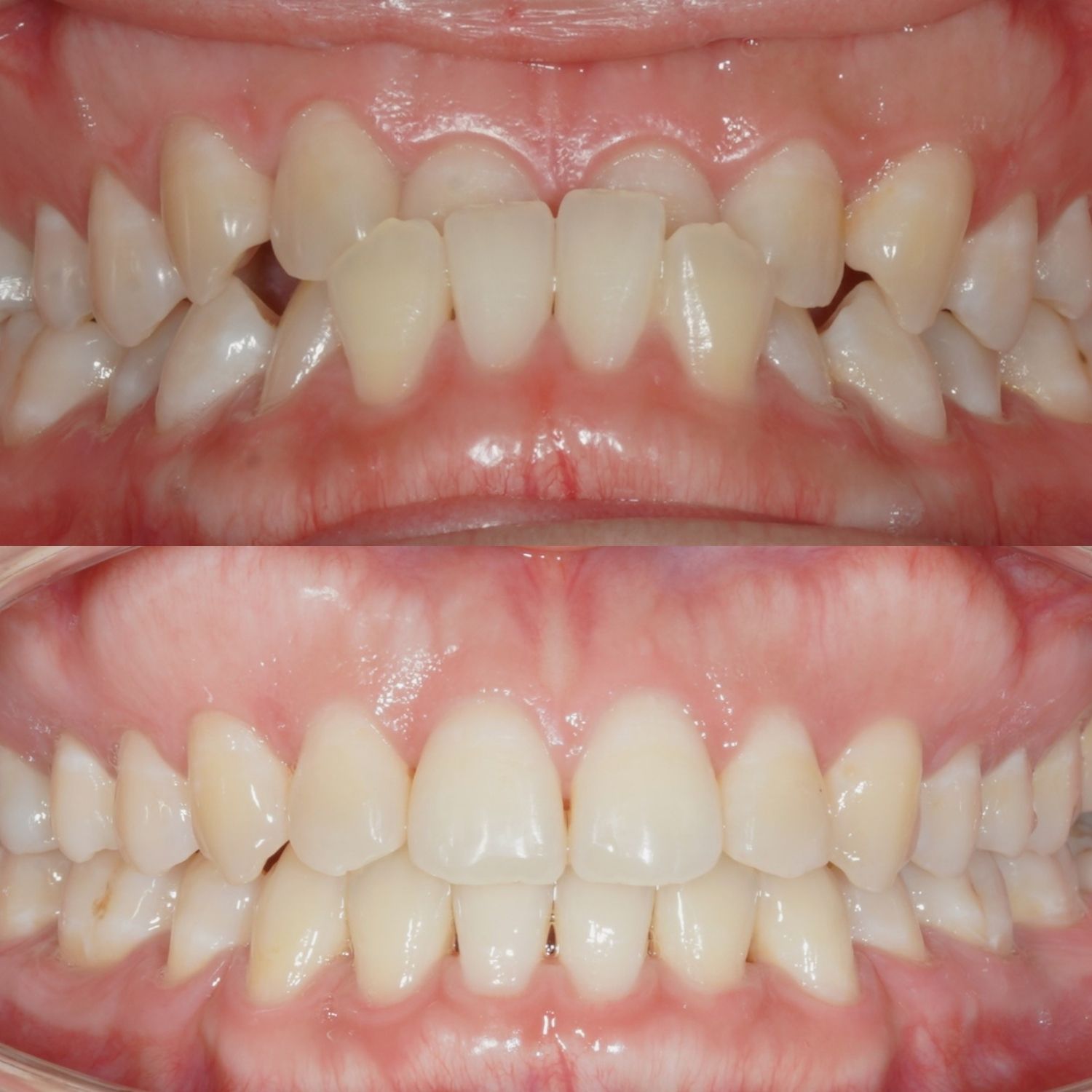 ảnh so sánh 2 hàm trước và sau khi niềng răng của Uyên. Răng đều, khớp cắn đã chuẩn