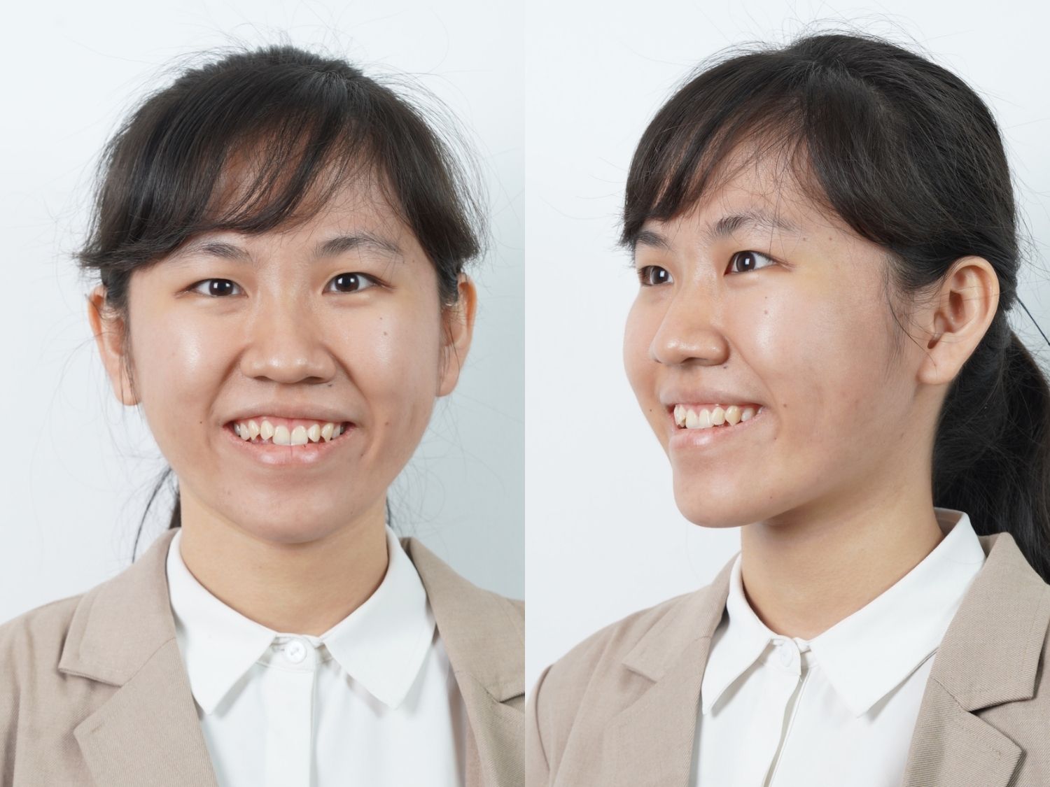 Hồ Huỳnh Thanh Uyên có tương quan xương hạng III và khớp cắn ngược