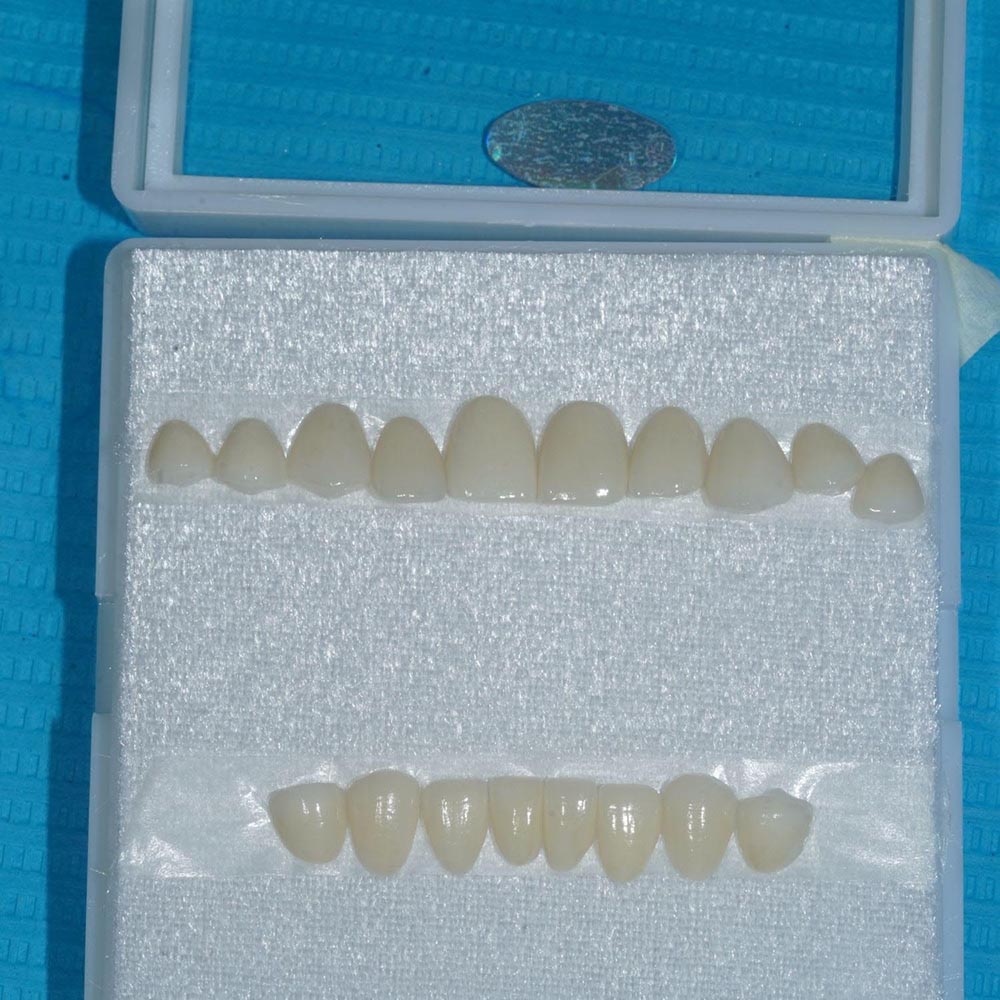 18 mặt dán sứ LiSi được thiết kế theo răng của Minh Dương