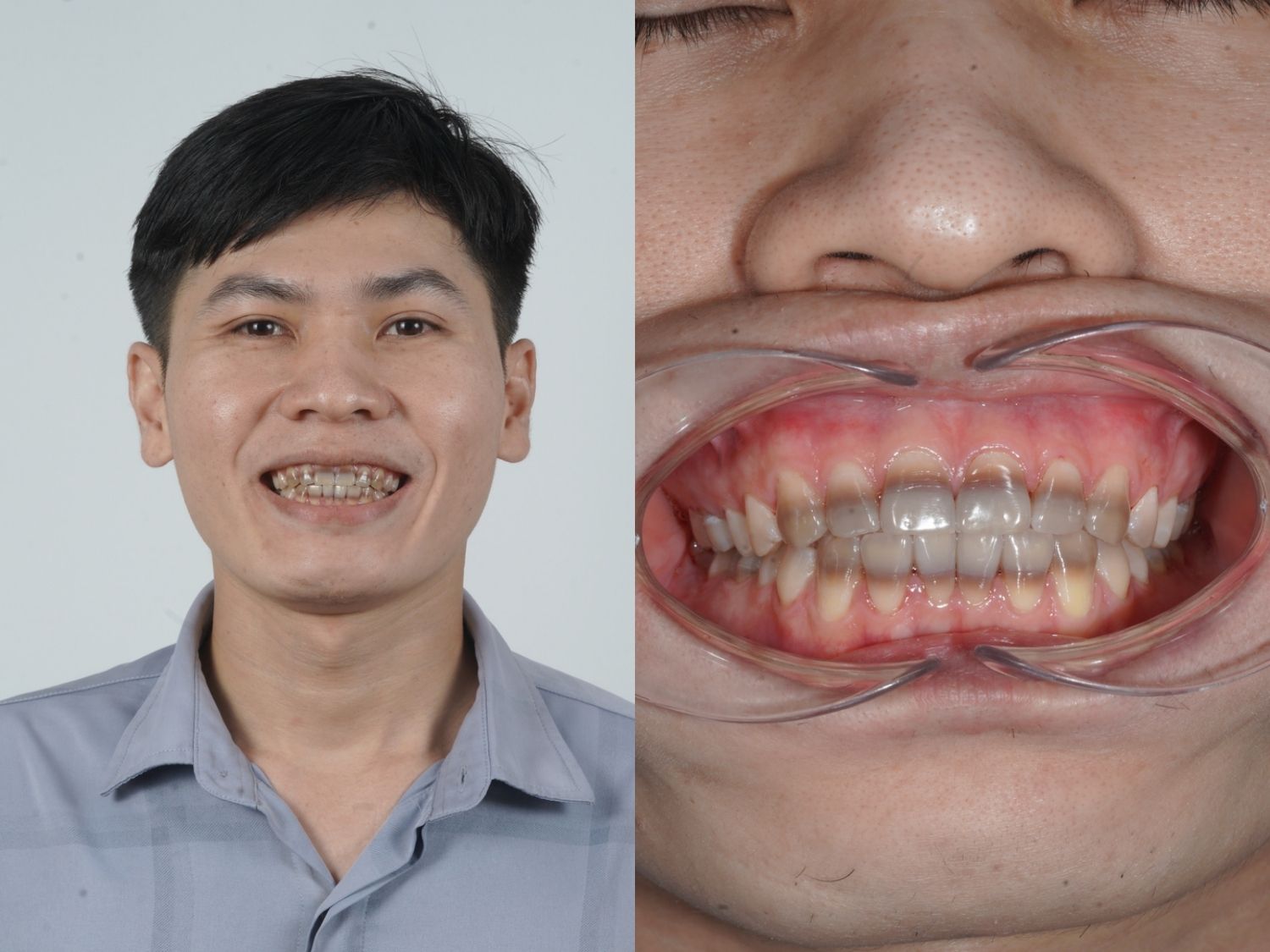 tình trạng răng của Huỳnh Minh Dương nhiễm màu nặng, ảnh hưởng đến vẻ bề ngoài