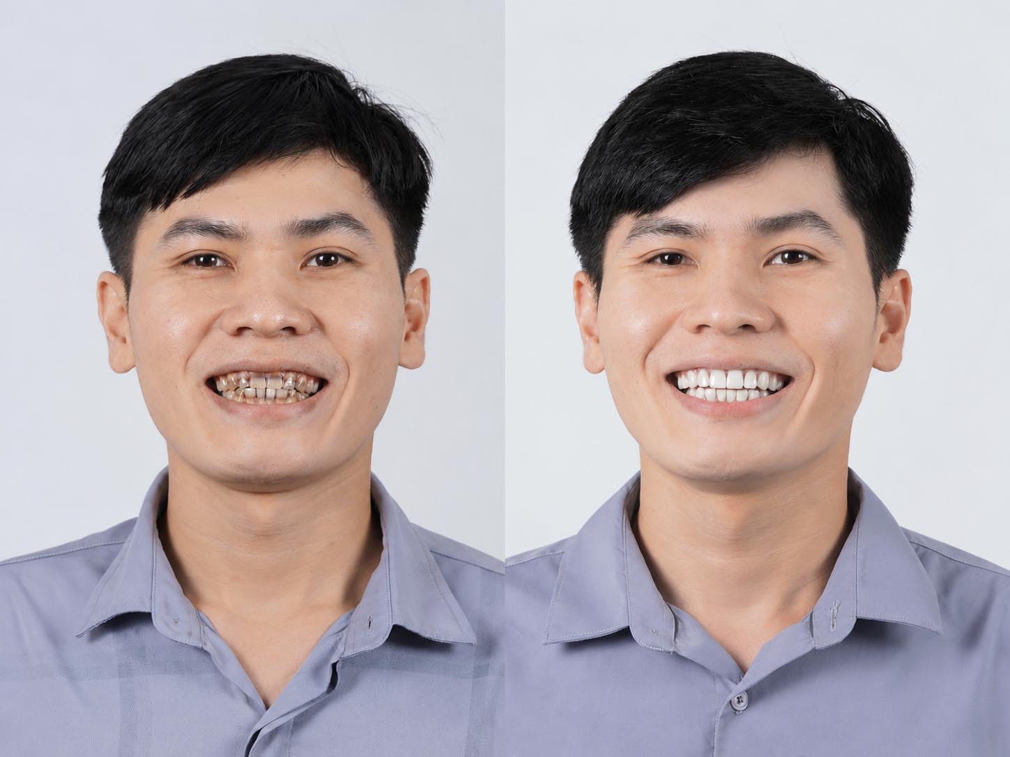 ảnh so sánh trước và sau khi dán sứ veneer cho Minh Dương, sở hữu nụ cười tự tin