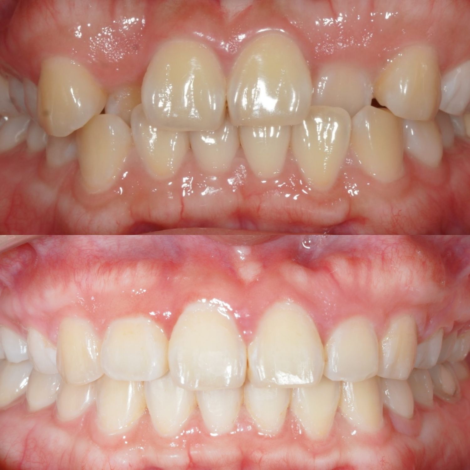 ảnh so sánh trước và sau khi chỉnh nha của Mỹ Phương
