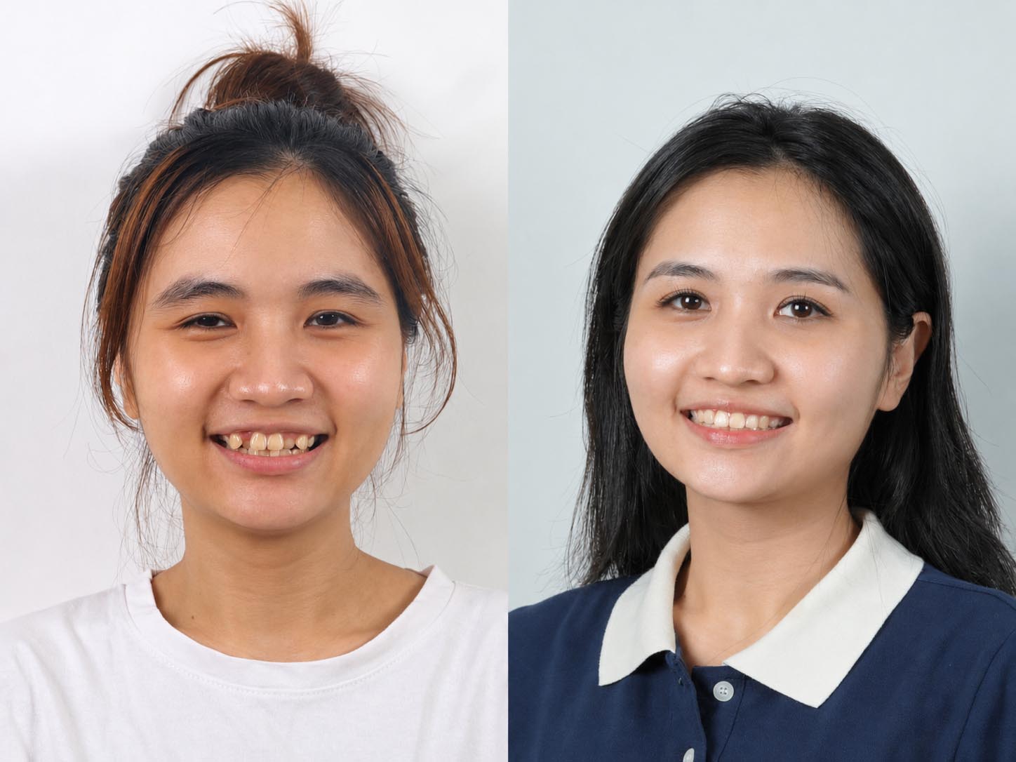 gương mặt gọn hơn, nụ cười tự tin và cân đối sau khi niềng răng