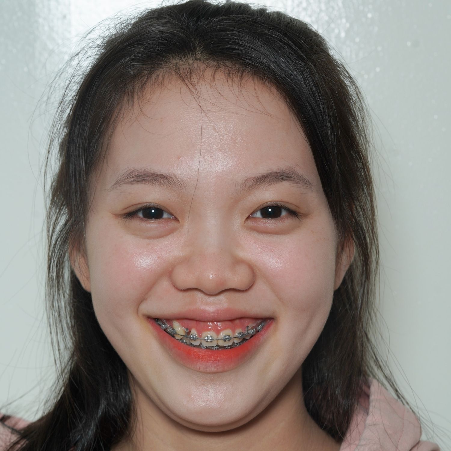 Kỳ Duyên trong hành trình niềng răng ban đầu