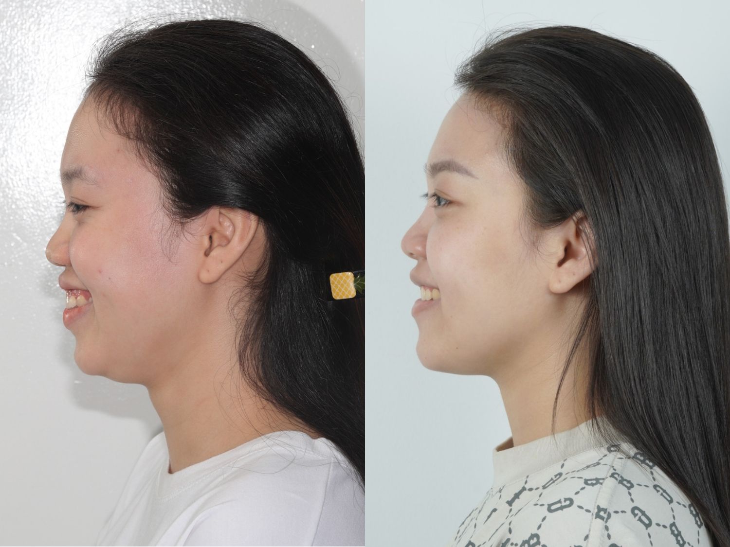 độ chìa cải thiện đáng kể, góc nghiêng đẹp hơn