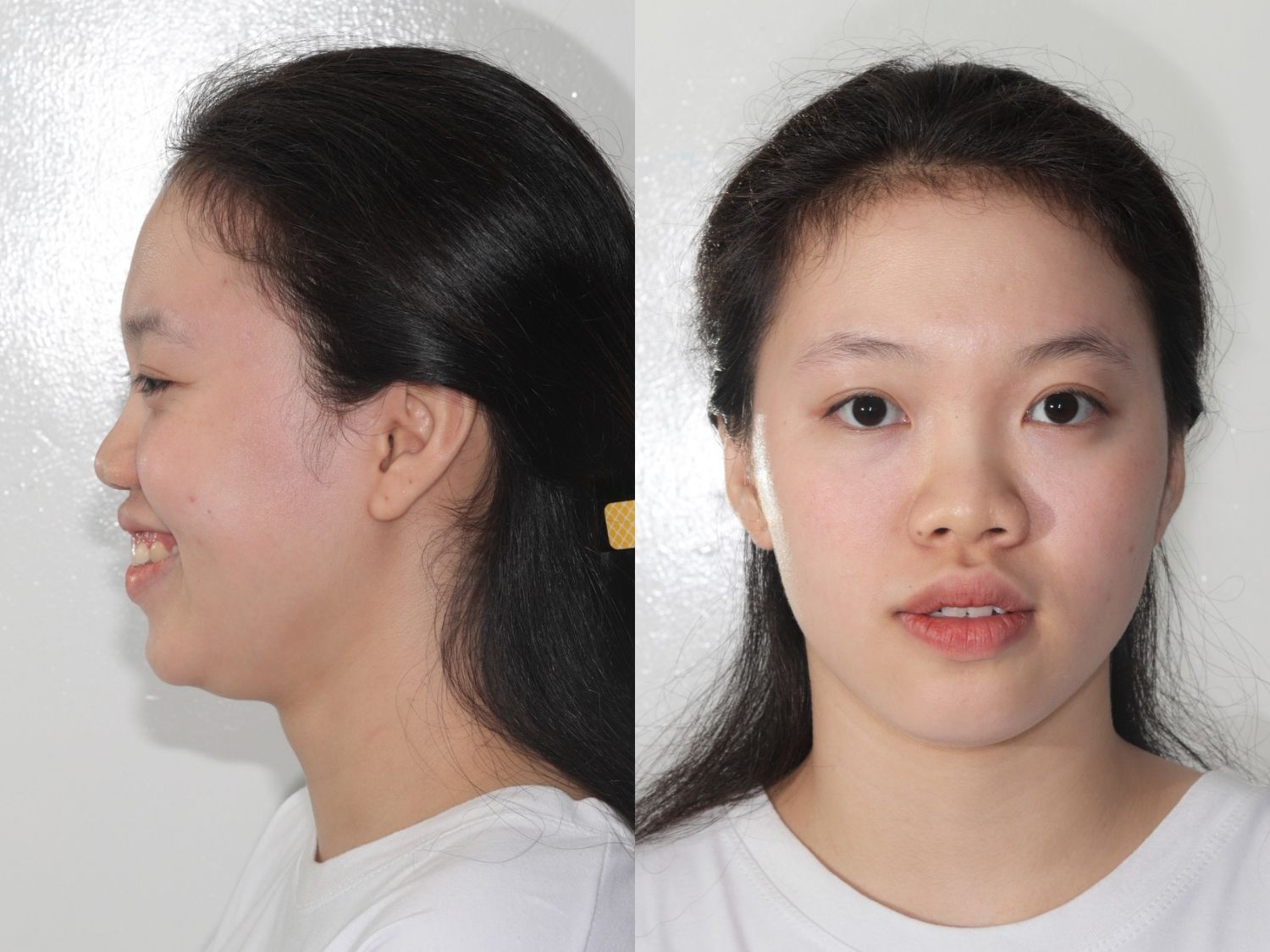 Kỳ Duyên có tình trạng hô hai hàm, nhóm răng phía trước nhô nhiều khiến gương mặt kém duyên và mất thẩm mỹ