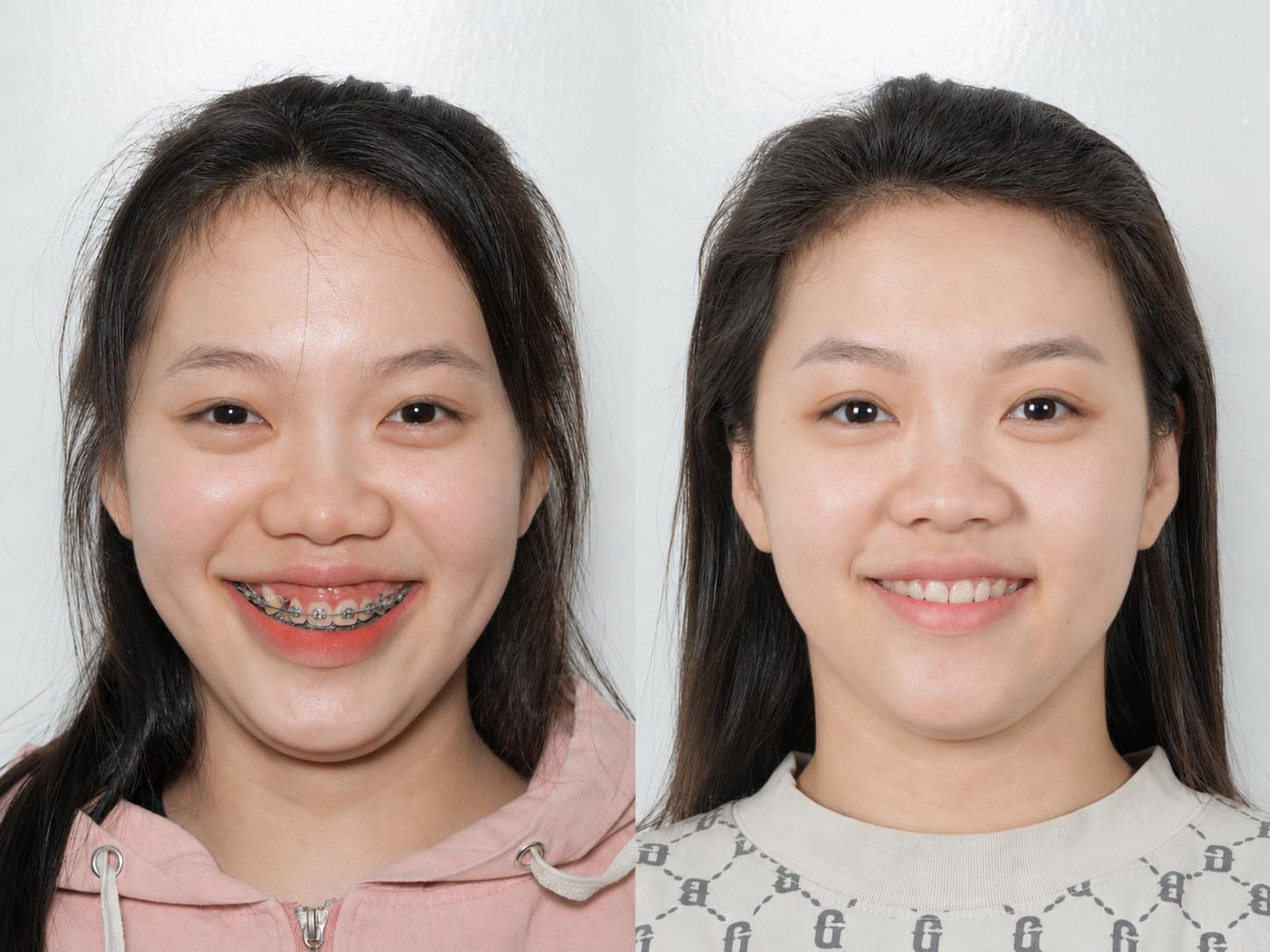 sự thay đổi rõ rệt của Duyên sau khi niềng răng