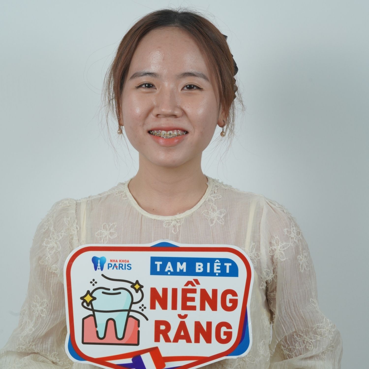 Uyên ở giai đoạn gần hoàn thiện khi niềng răng tại Nha khoa Paris