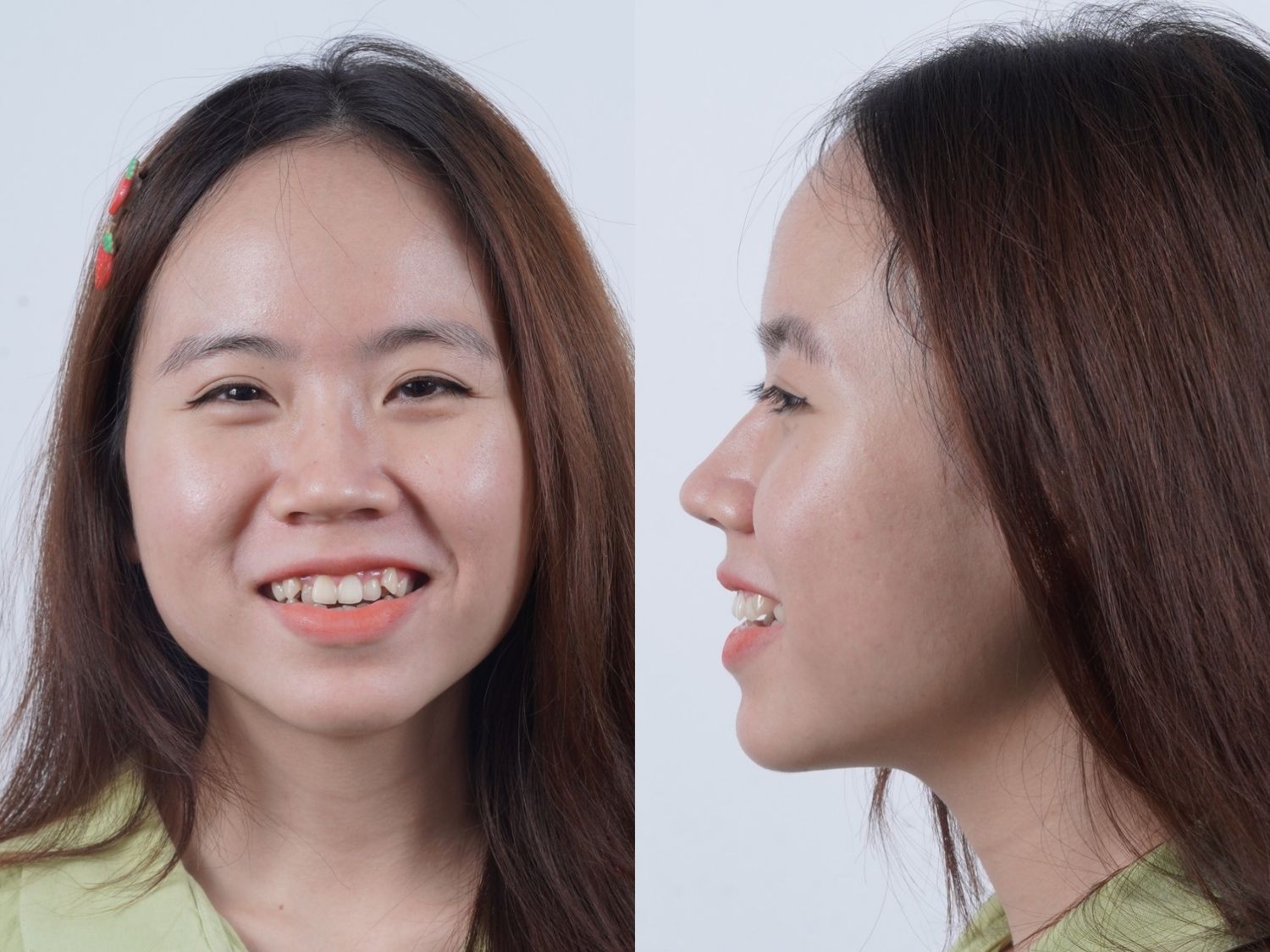 răng chen chúc và khấp khểnh của uyên trước khi niềng
