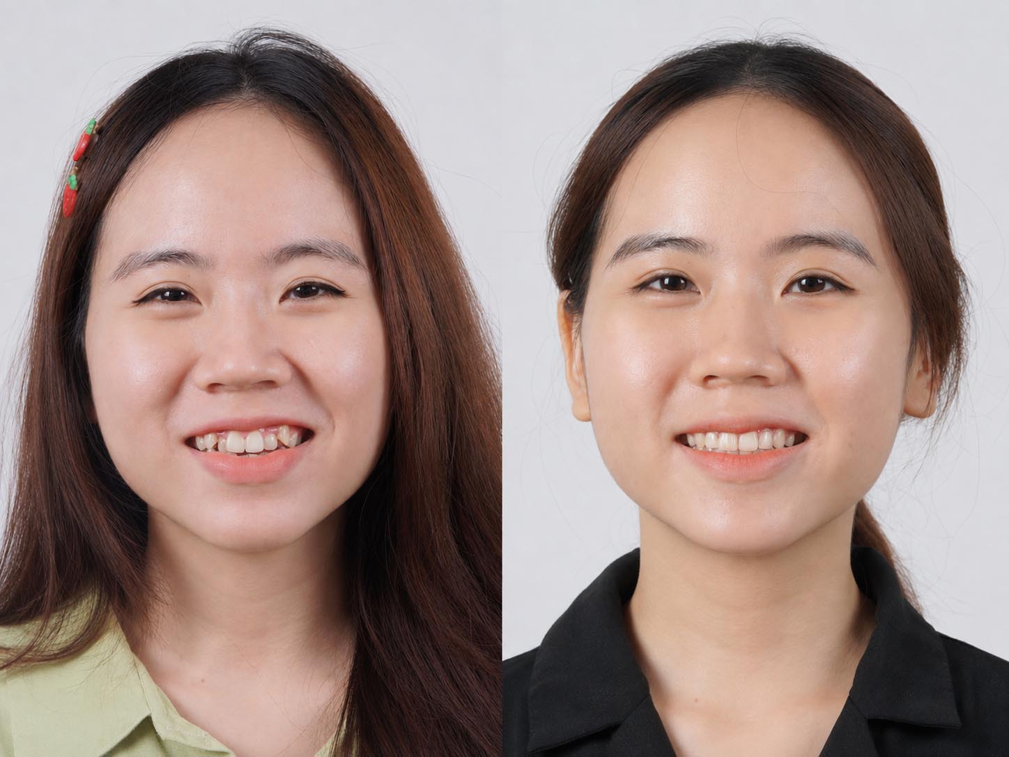 ảnh so sánh kết quả niềng răng của Uyên, răng đều, sắp xếp đúng trên cung hàm