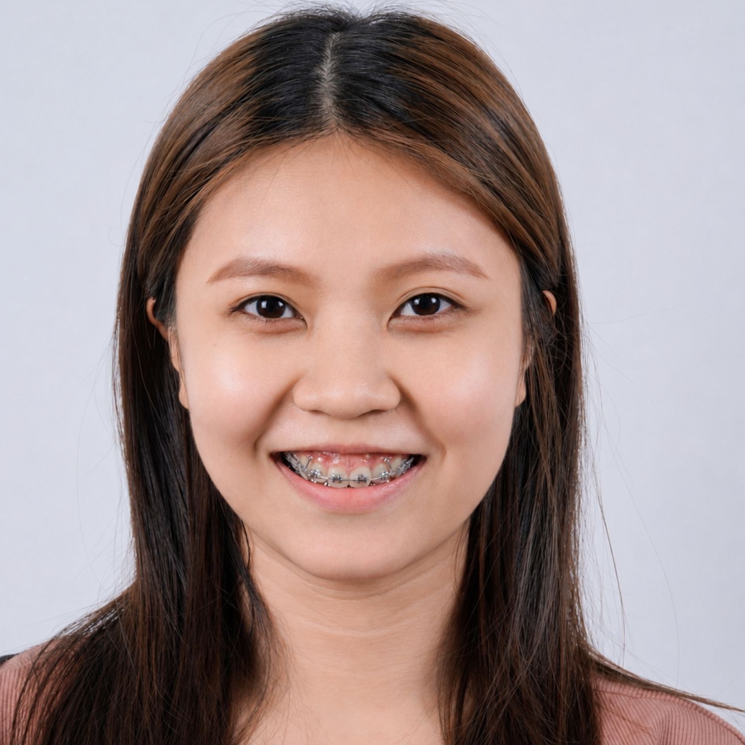 Quá trình niềng răng đã bắt đầu có sự thay đổi