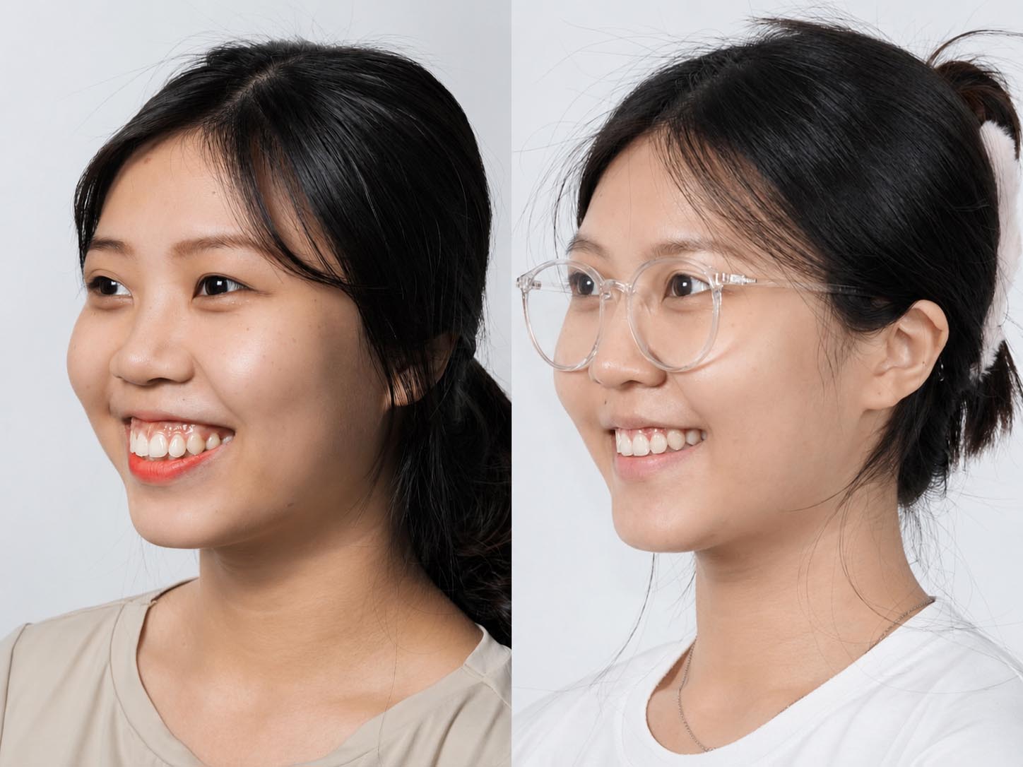 Thùy Dương trước và sau khi niềng răng, ảnh so sánh, nụ cười cân đối và gương mặt trẻ hơn