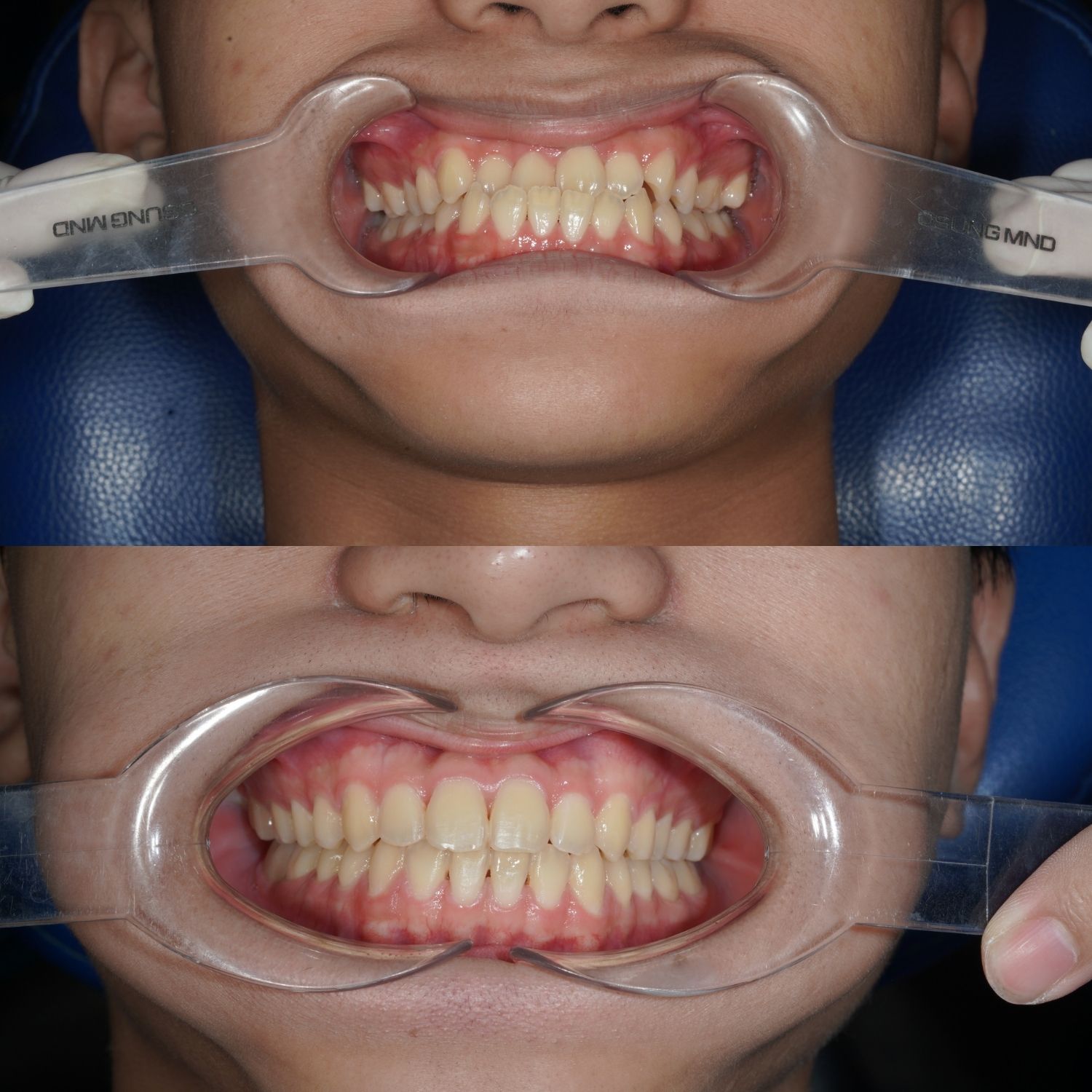 ảnh trước và sau khi chỉnh nha, răng đều đẹp và khuôn hàm cân đối