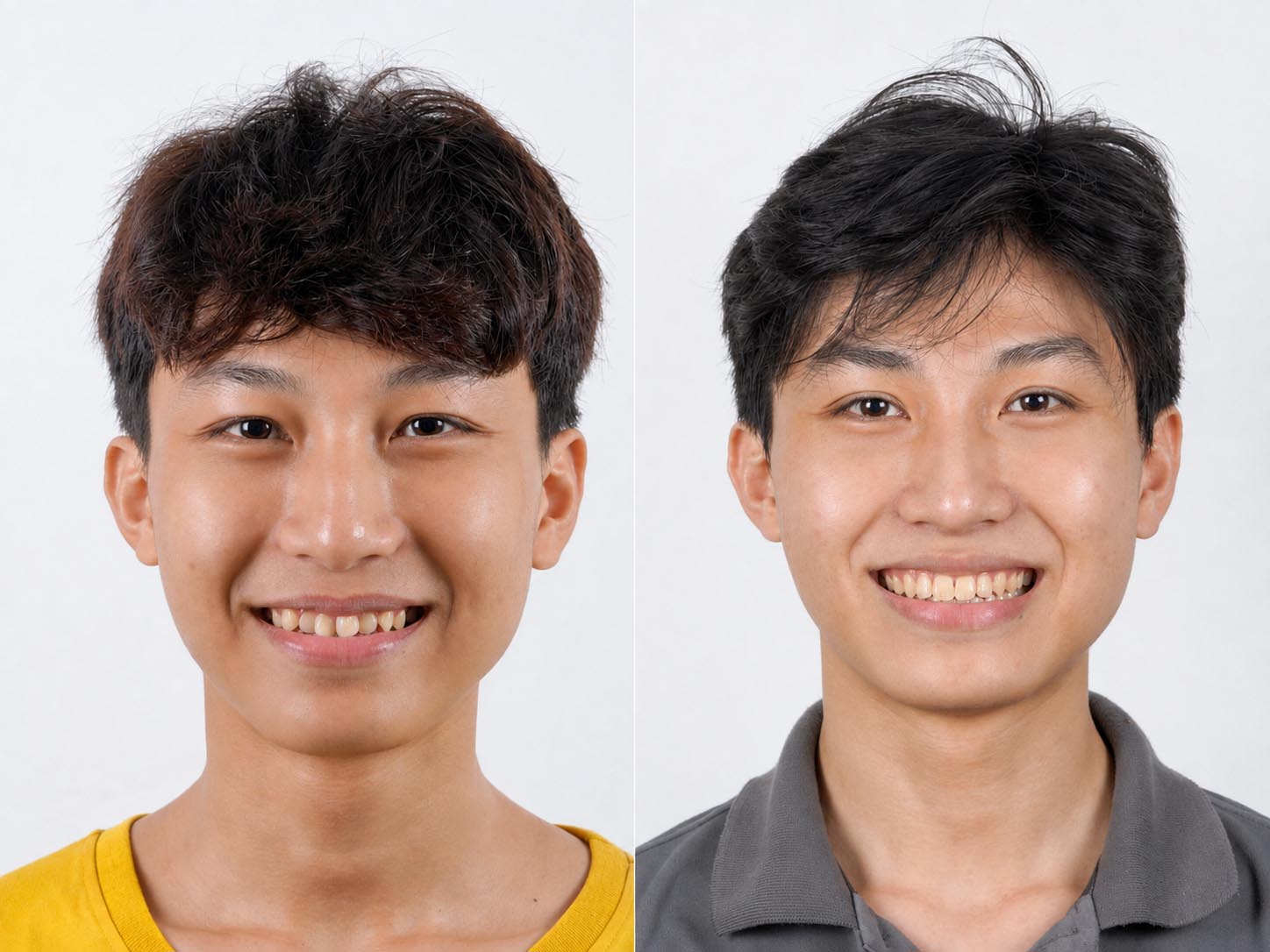 ảnh so sánh trước và sau khi niềng răng, khớp cắn đã hài hòa, khuôn miệng cười tươi và đẹp hơn