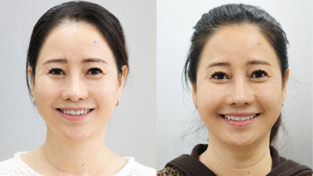 ảnh khách Kim Phúc trước và sau khi dán răng sứ, nụ cười tươi và tự tin hơn