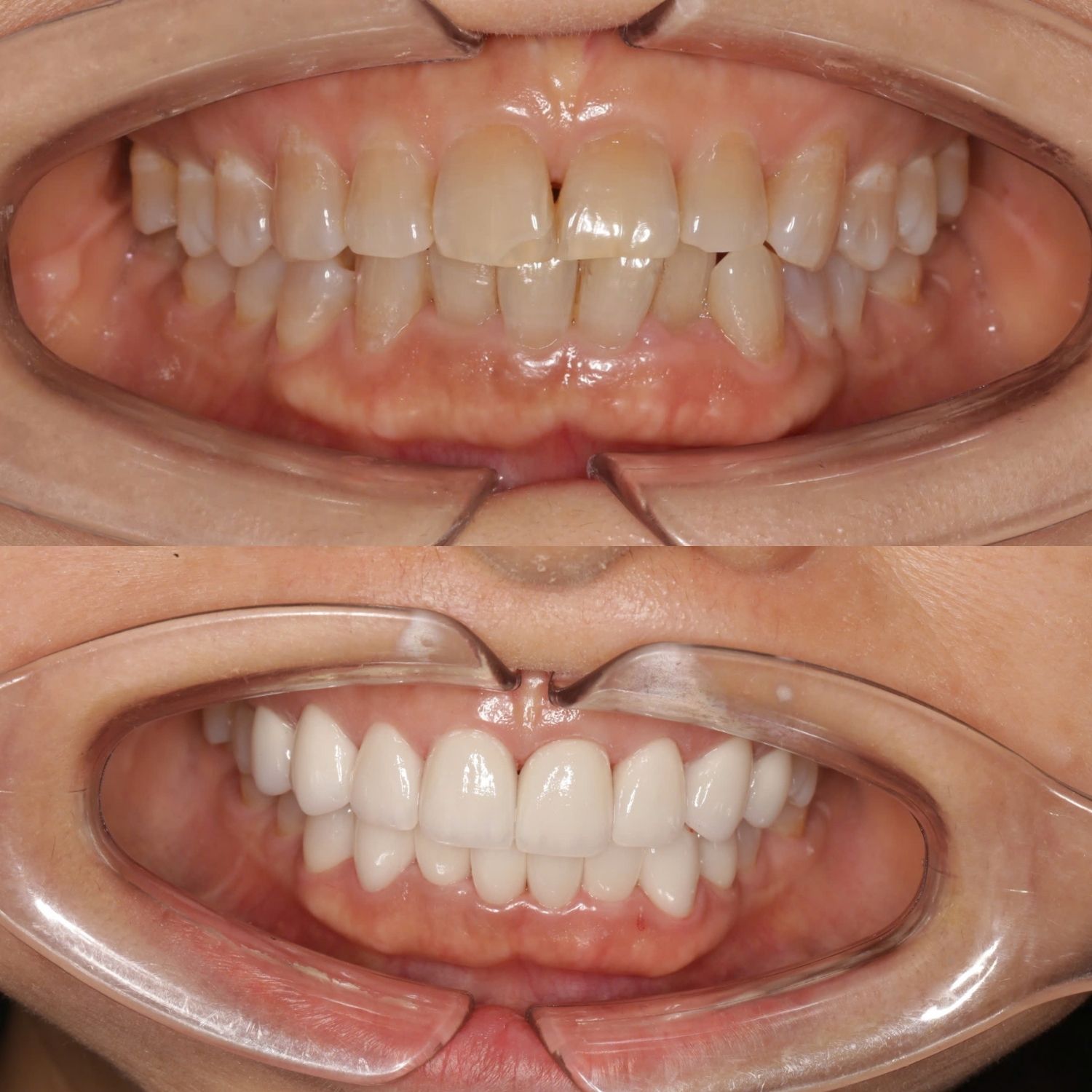 răng xỉn màu trước và sau khi dán sứ, răng đều đẹp, sáng và có tính thẩm mỹ hơn