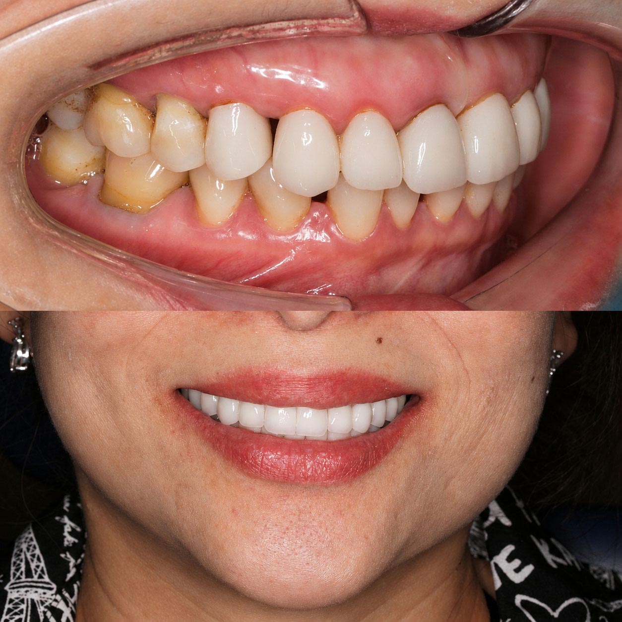 ảnh trước và sau khi bọc răng sứ của khách hàng Tuyết Hằng