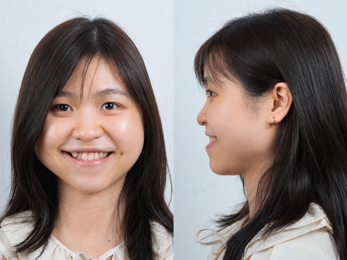 Quỳnh Như có răng chen chúc nhiều ở cả hai hàm, khớp cắn ngược khiến tương quan giữa hàm trên và hàm dưới chưa phù hợp