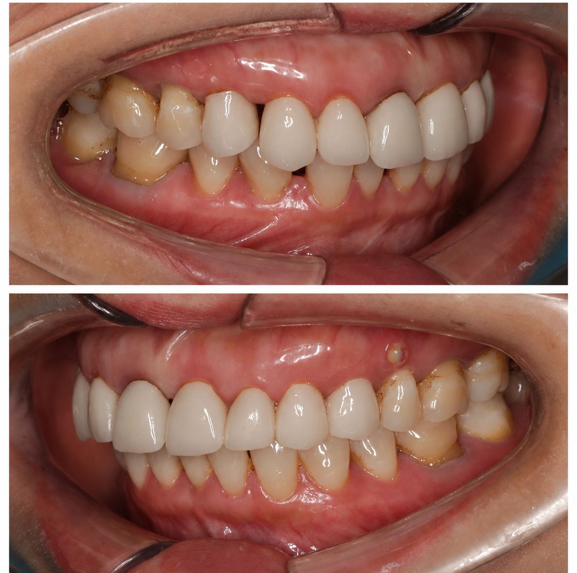Tình trạng răng sứ cũ ố vàng, hở cổ răng