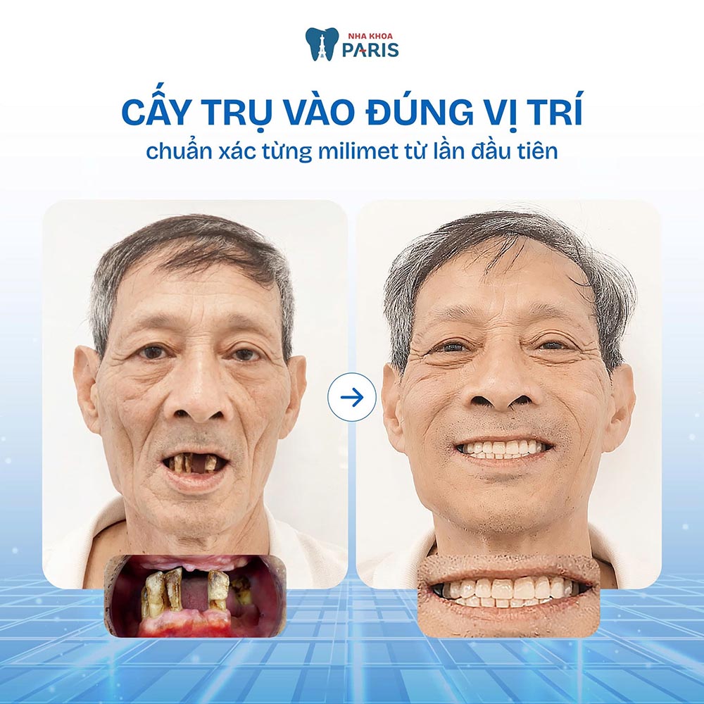 Khách hàng trồng răng Implant tại Nha khoa Paris