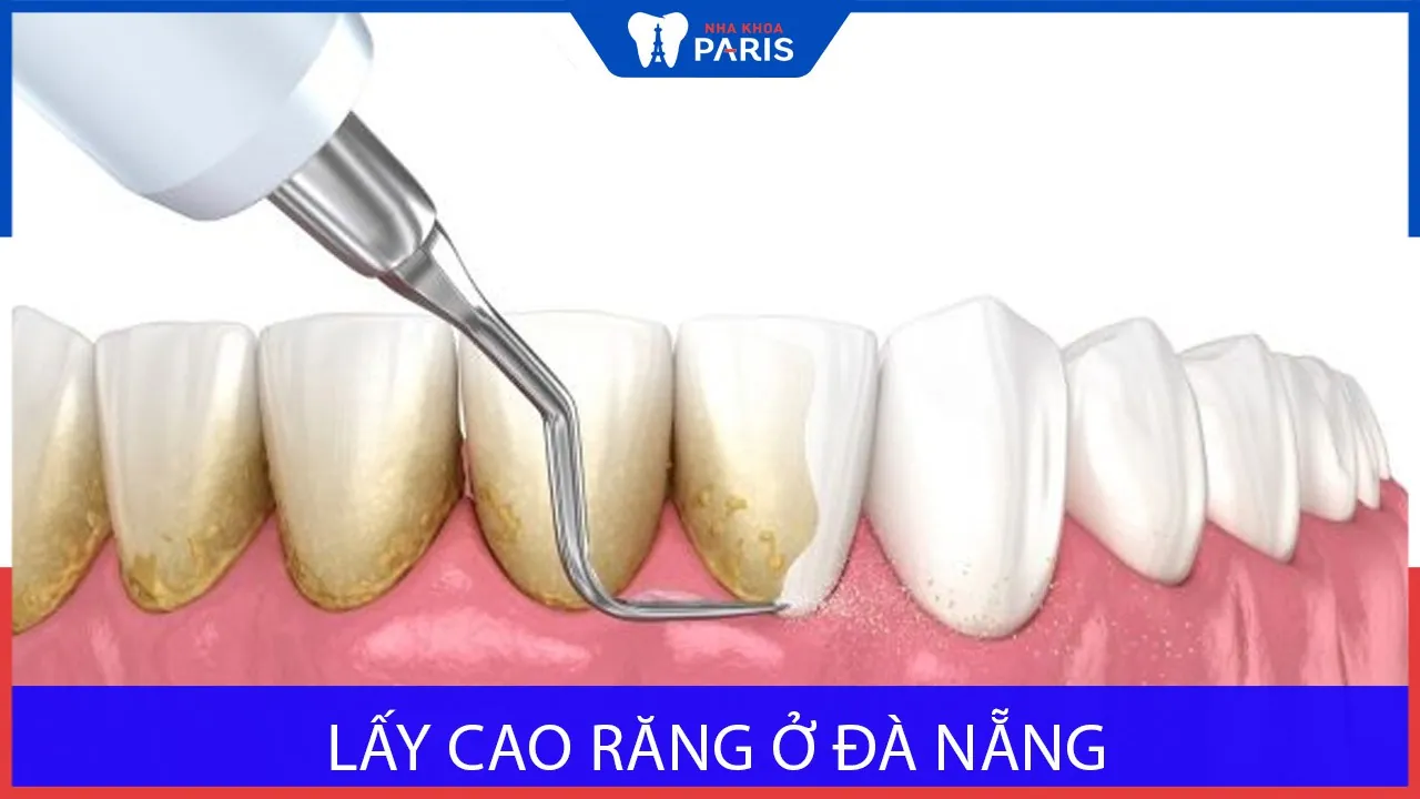Lấy cao răng ở Đà Nẵng có tốt không? Giải đáp bởi chuyên gia