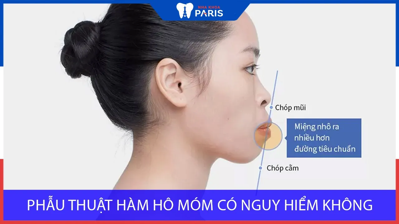Phẫu thuật hàm hô, móm có nguy hiểm không? Có để lại di chứng ko?