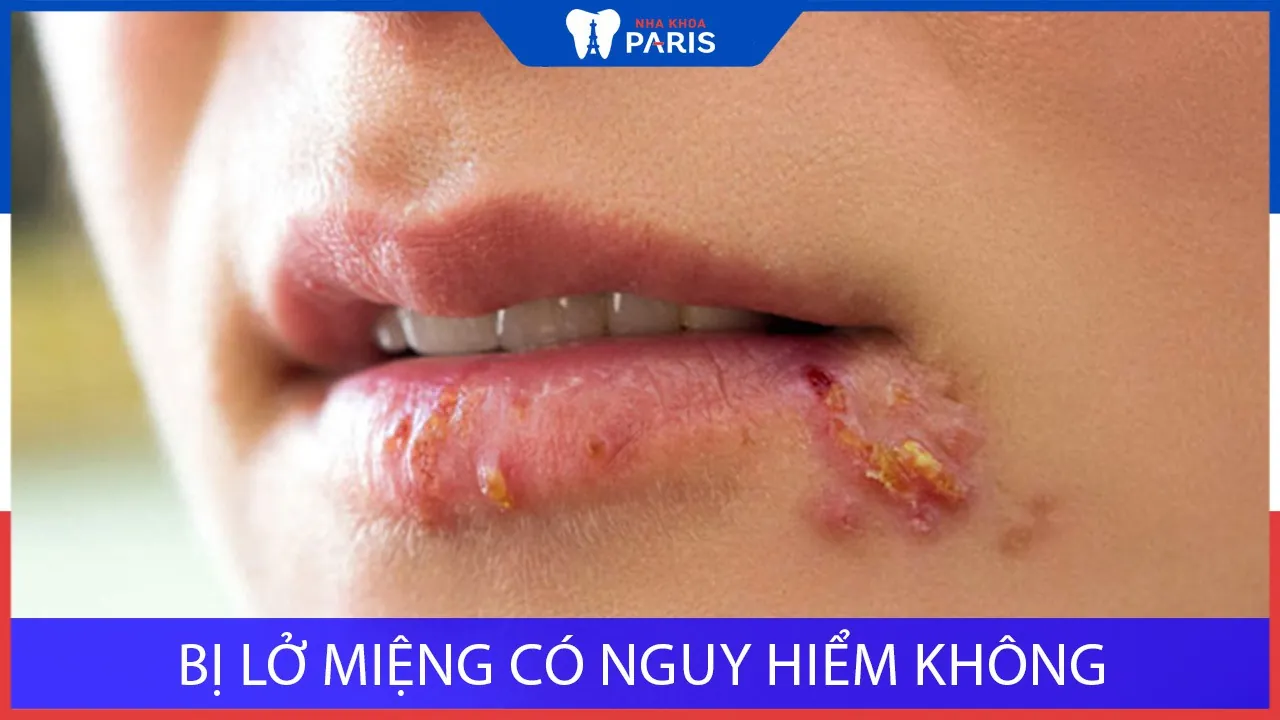 Bị lở miệng có nguy hiểm không? Làm sao hết lở miệng?