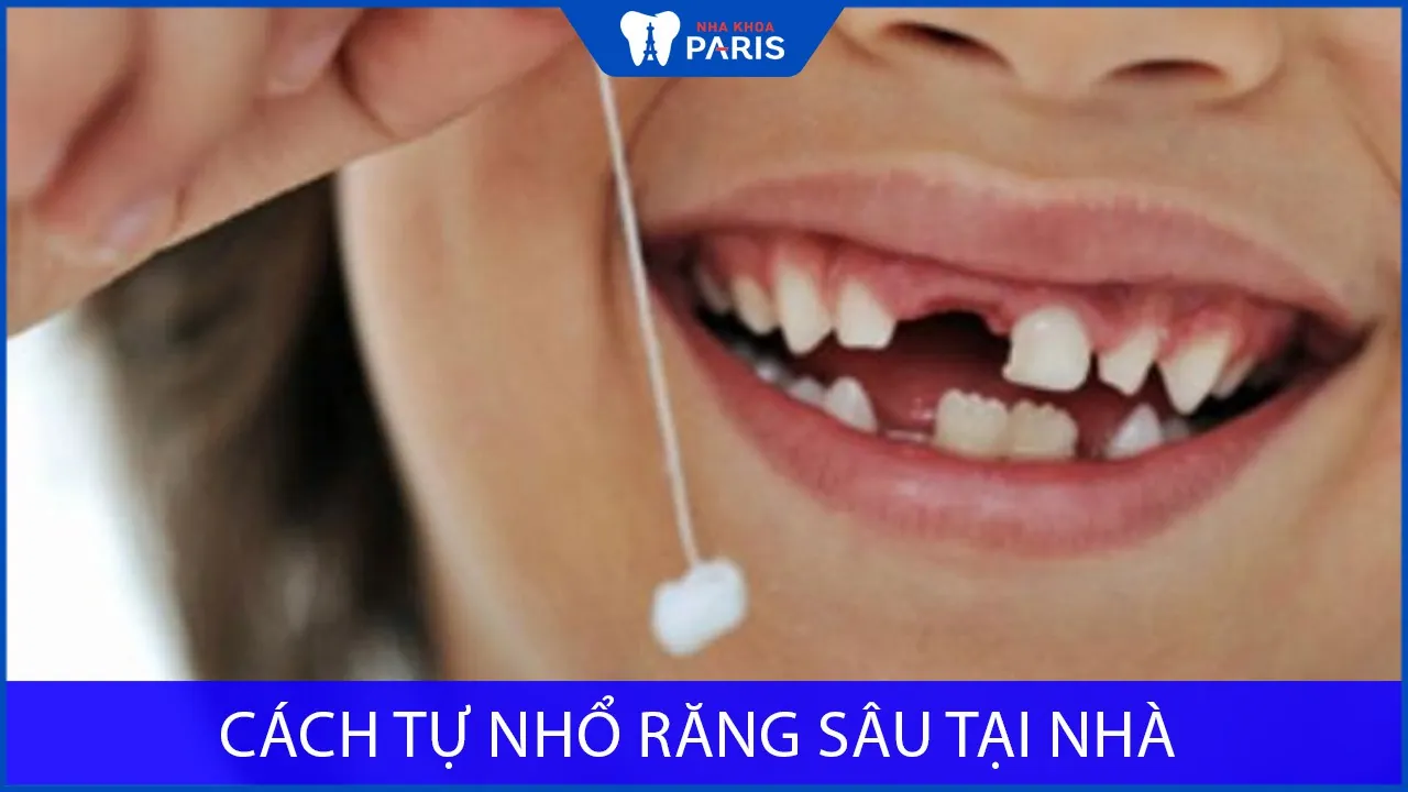 Cách tự nhổ răng sâu tại nhà chớp nhoáng chỉ trong 1 phút