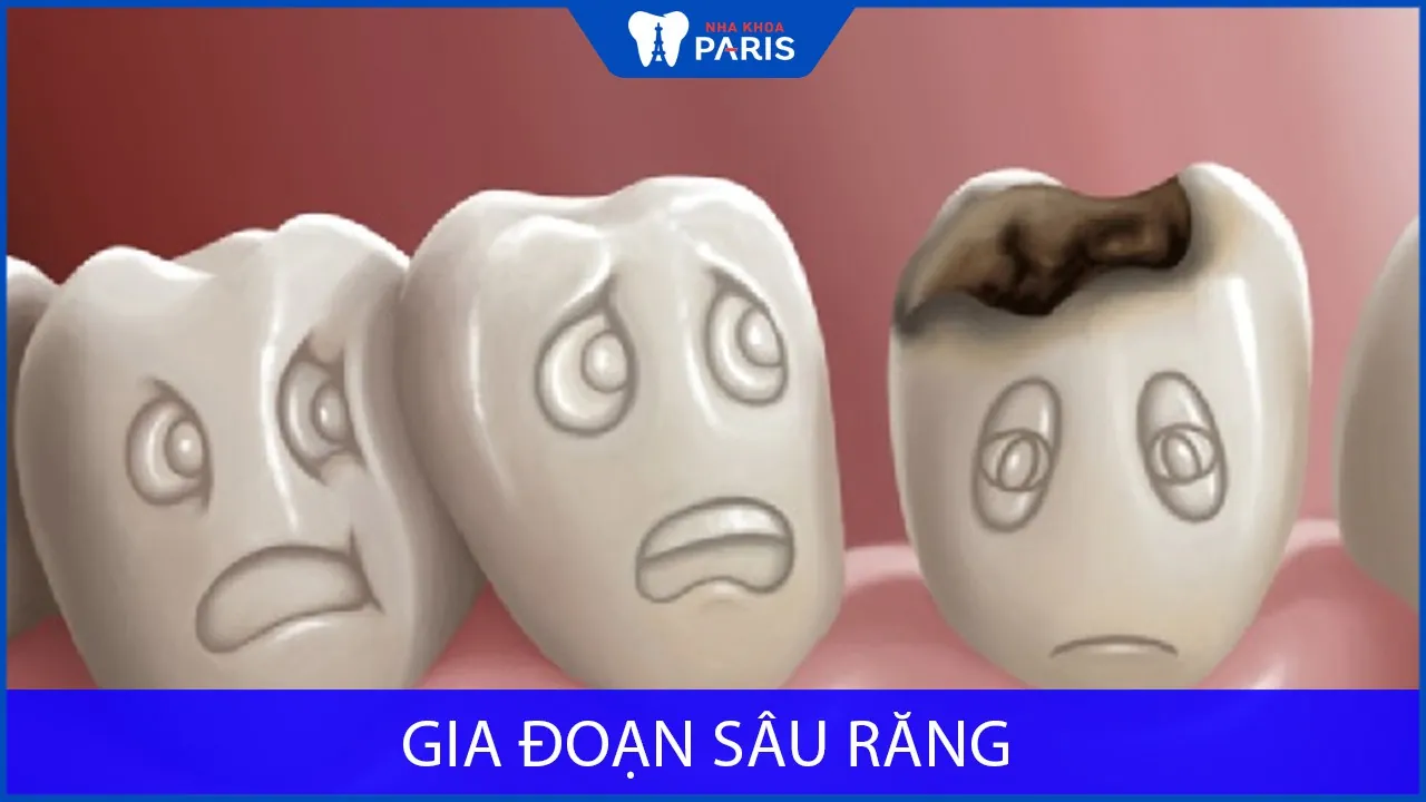 Hình ảnh sâu răng qua các giai đoạn phát triển của bệnh