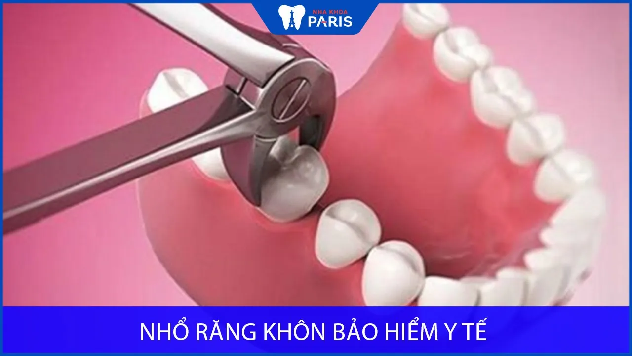 Những thông tin QUAN TRỌNG khi nhổ răng khôn bảo hiểm y tế