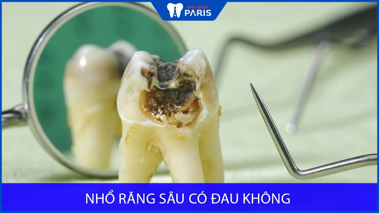 Nhổ răng sâu có đau không? Review khách hàng