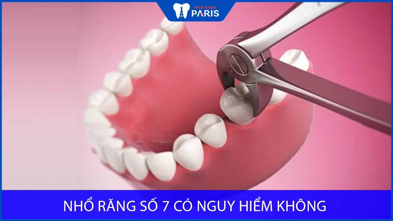 Nhổ răng số 7 có nguy hiểm không? Giá bao nhiêu tiền là hợp lý?