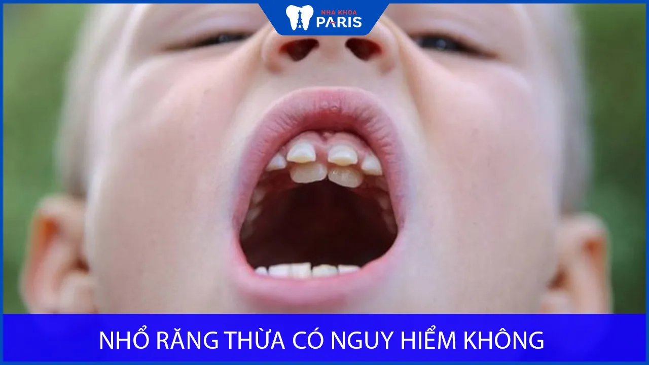 Nhổ răng thừa có nguy hiểm không? Phương pháp nhổ răng