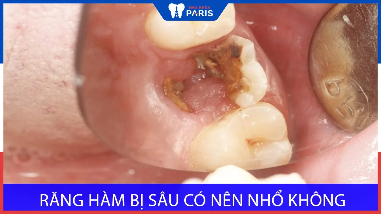Răng hàm bị sâu có nên nhổ đi không? Bác sĩ GIẢI ĐÁP