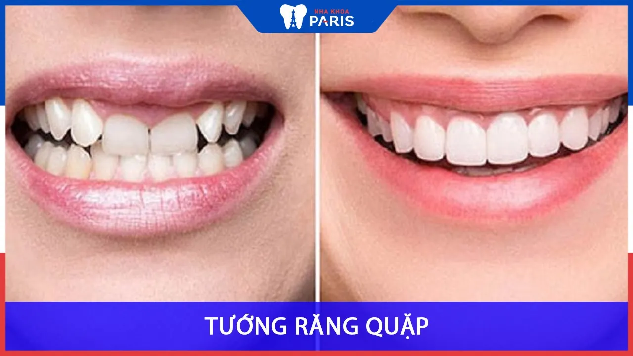 Răng quặp ki bo: Tướng răng quặp là như thế nào?