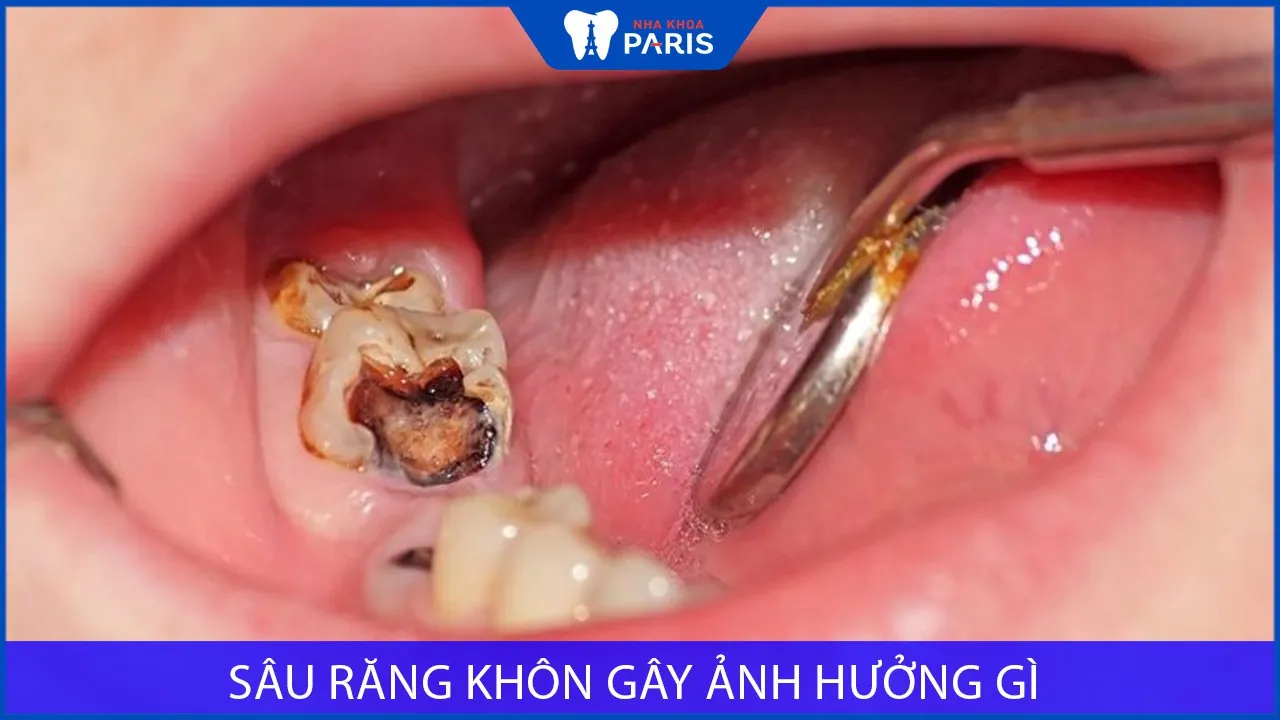 Sâu răng khôn gây ảnh hưởng gì? Phải làm sao khắc phục