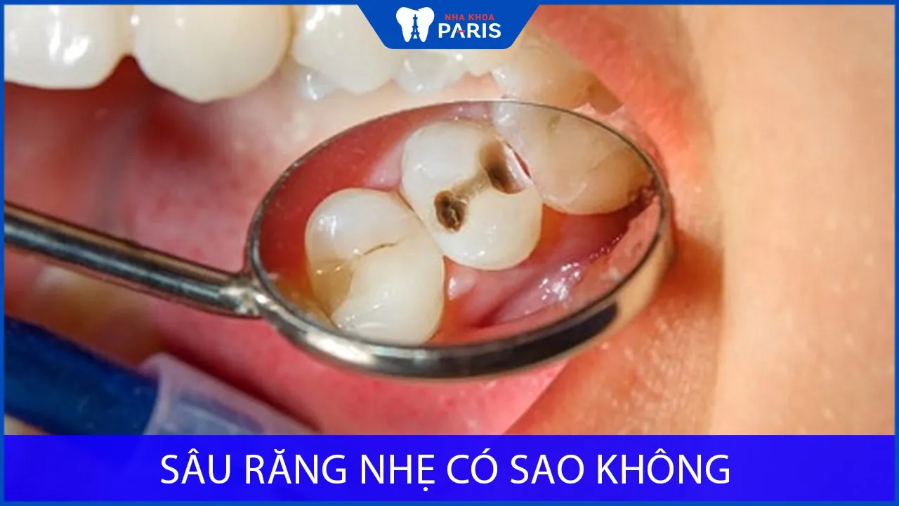 Sâu răng nhẹ có sao không? Cách chữa sâu răng nhẹ HIỆU QUẢ
