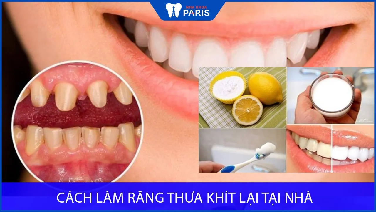 Cách làm răng thưa khít lại tại nhà như thế nào? Có hiệu quả không?