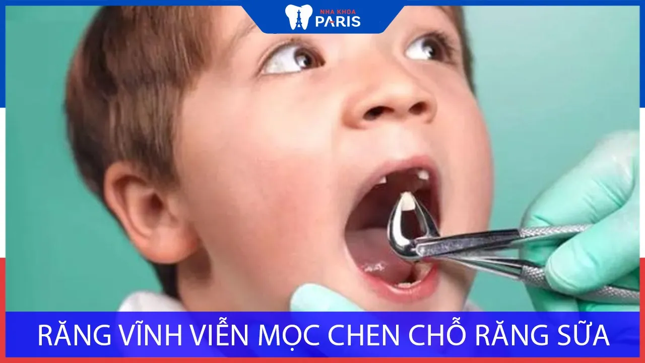Răng sữa chưa rụng răng vĩnh viễn đã mọc thì giải quyết thế nào?