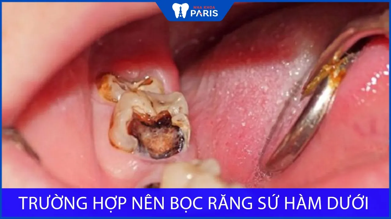 Top 5 trường hợp nên thực hiện bọc răng sứ hàm dưới