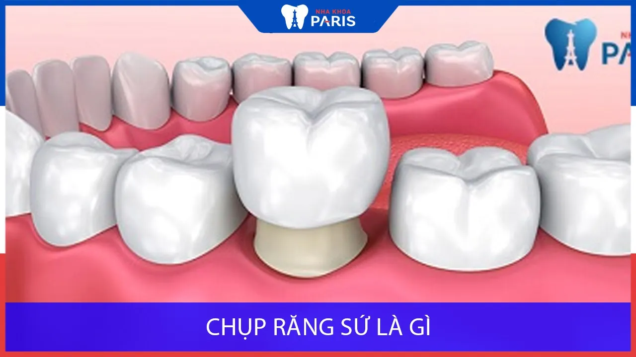 Chụp răng sứ là gì? Có gây ra cảm giác khó chịu khi thực hiện không?