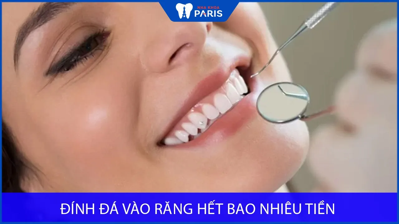 Đính đá vào răng hết bao nhiêu tiền? Bảng giá mới 2025