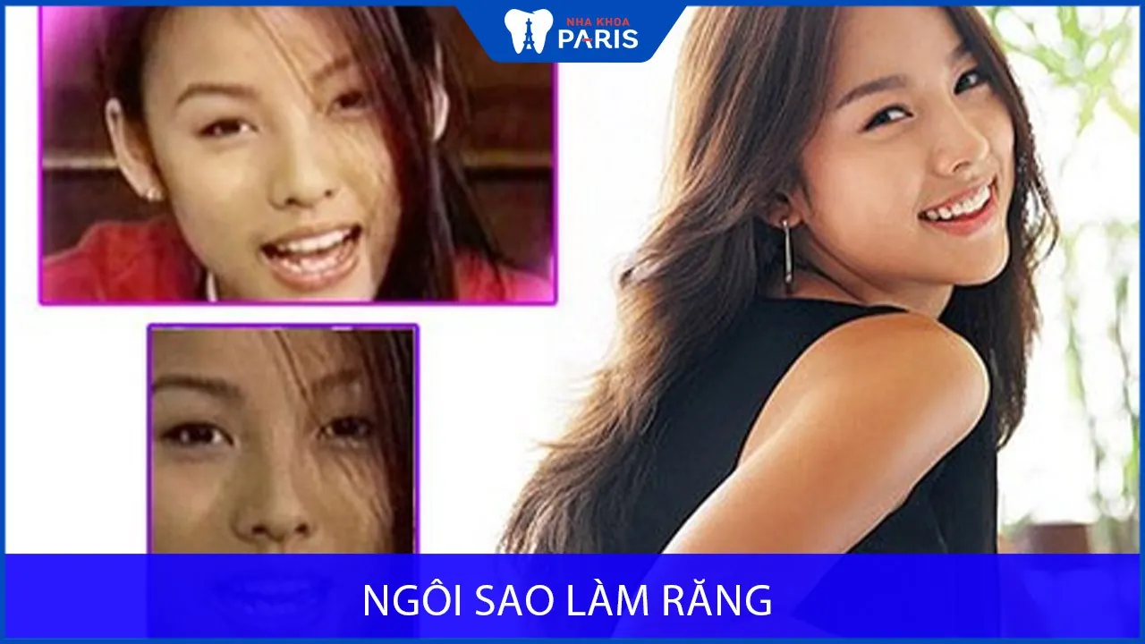 Những ngôi sao làm răng sứ giúp đổi mới nụ cười