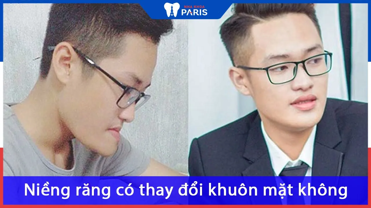 Niềng răng có thay đổi khuôn mặt không? Thay đổi như thế nào?