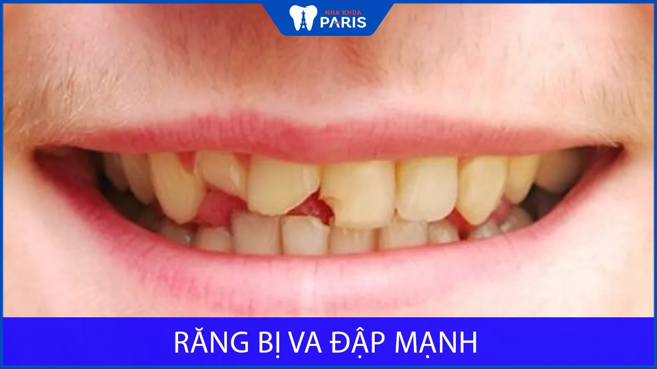 Răng bị va đập mạnh gây hậu quả thế nào? Cách xử lý nhanh