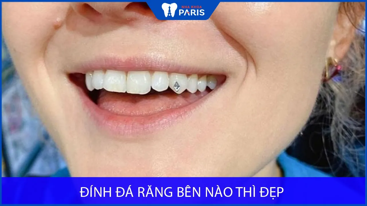 Đính đá răng bên nào thì Đẹp, Nổi Bật, Thu Hút ánh nhìn?